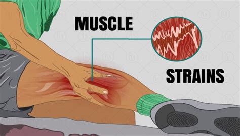 muscle strain symptoms and treatment